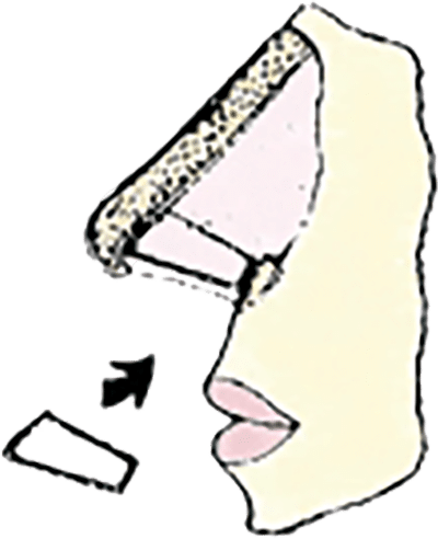 nasal valve support nasal valve support